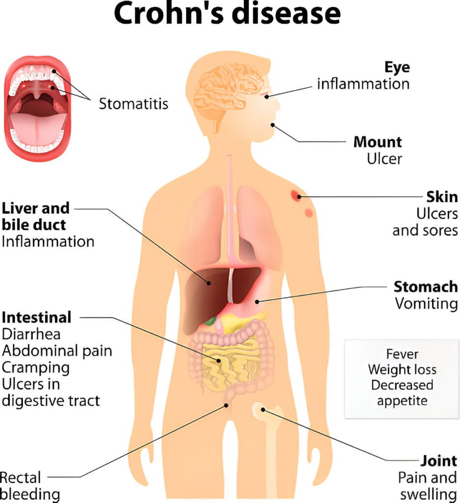 crohns illness signs and symptoms